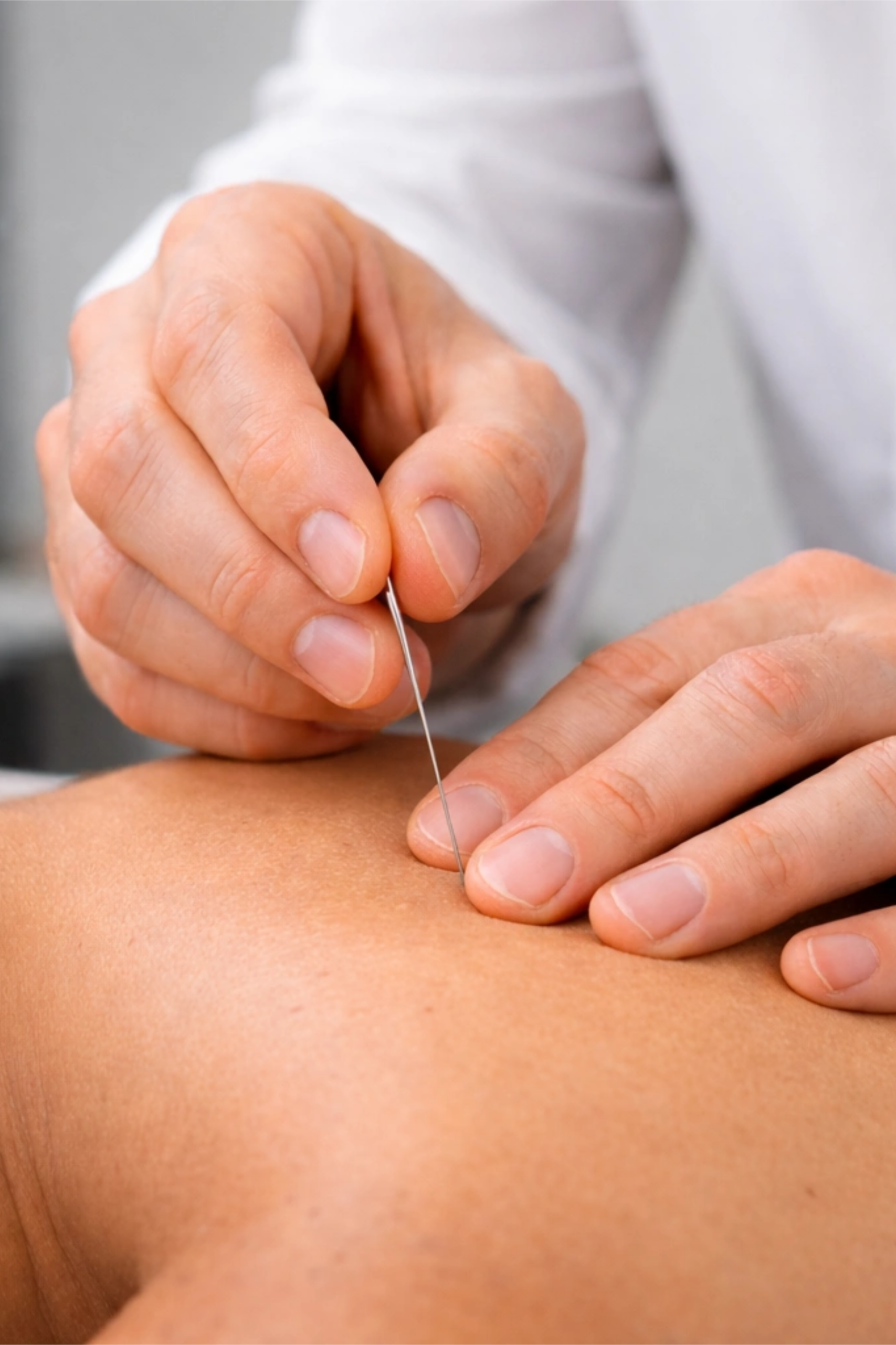Close up of dry needling