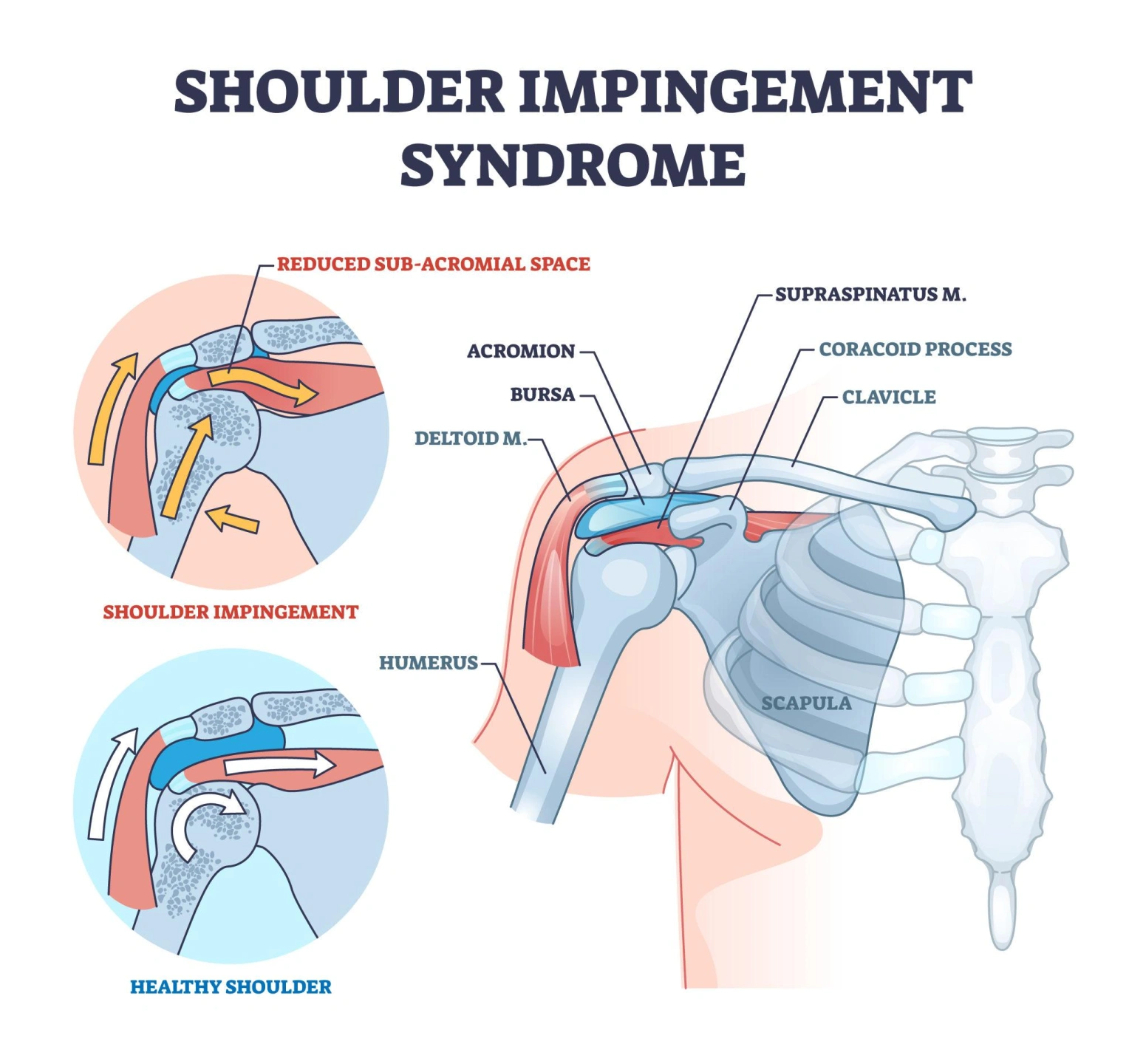 Diagram of shoulder impingement syndrome